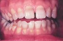 macchie smalto denti tetraciclina dentista sbiancamento 
